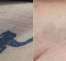 Before and After Laser Tattoo Removal on the Pelvic Region