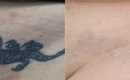 Before and After Laser Tattoo Removal on the Pelvic Region