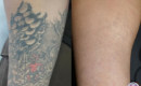 Before and After Laser Tattoo Removal on the Forearm