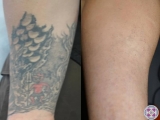 Before and After Laser Tattoo Removal on the Forearm