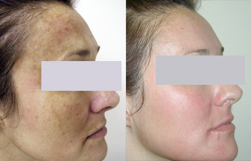 Before and After Laser Melasma Treatment