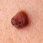Birthmark removal treatments can also remove Congenital Moles