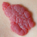 Hemangiomas can be removed with our laser treatments