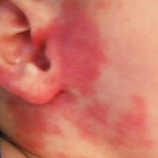 Port-wine Stain birthmarks can be removed with lasers