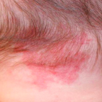 Salmon Patch birthmarks can be successfully removed with our laser birthmark removal treatments