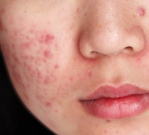 Stress can cause the onset of adult acne.