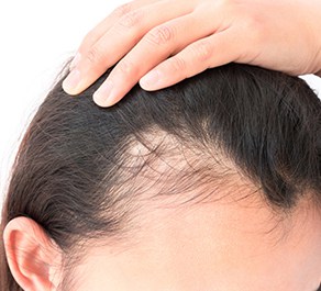 Hair loss is one of the physical effects of stress on the body.