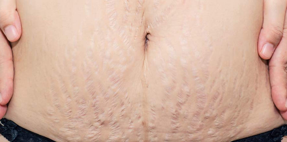 Which treatments actually work to get rid of stretch marks?