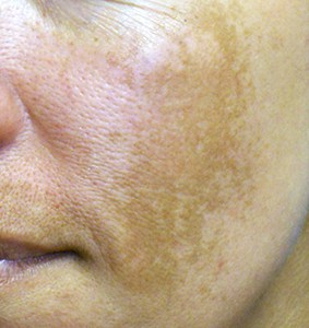 The dark patches of Melasma on the cheek