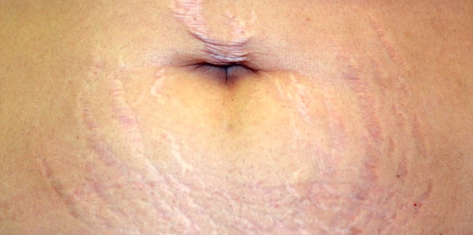 Stretch marks on the stomach caused by pregnancy