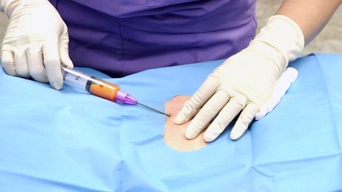 Harvesting fat from a patient's belly. Stem cells from fat are commonly used in clinical medicine.