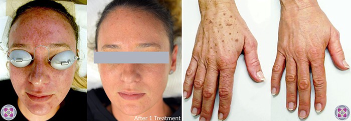 Before and after laser treatment to repair sun damaged skin.