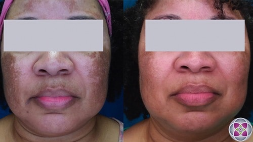 Before and after laser treatment for melasma on a patient with darker skin.