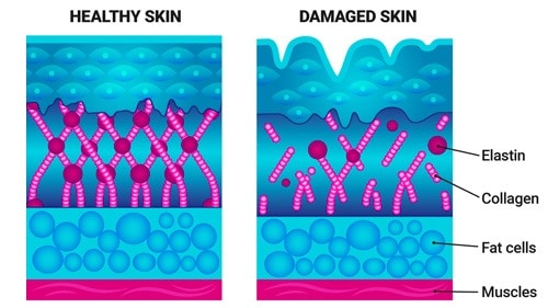 Your highly organized collagen is broken down by the sun and replaced with defective elastin fibers.