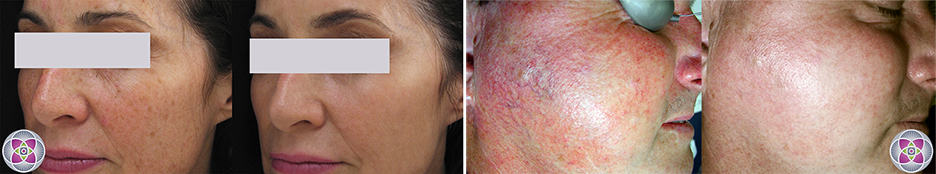 Lasers are the secret of how to look younger - Before and After laser treatment for Age Spots (left) and Rosacea (right)