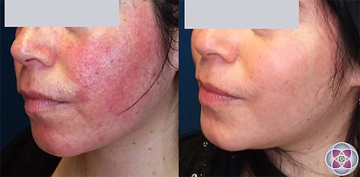 Before and After photo of a patient who underwent laser treatment for her rosacea.