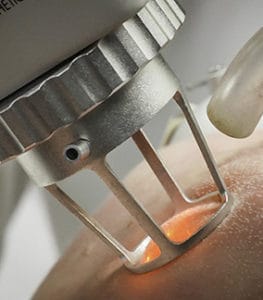 The CO2 Fractional Laser is one of several lasers used during the SpectraLift™ procedure