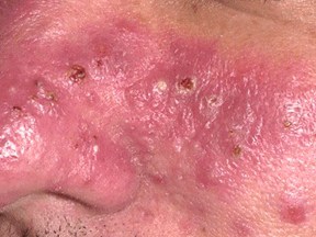 Inflammatory Rosacea: Skin that is inflamed, sensitive to touch, oozing and oily