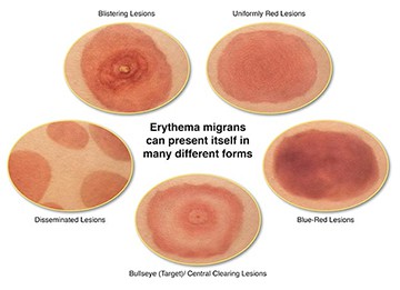 Lyme disease rash - The early signs of Lyme disease
