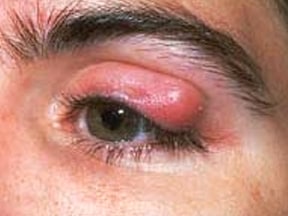 Ocular Rosacea : Swelling and redness of the eyes
