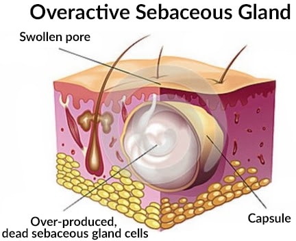 An over-active sebaceous gland is what causes acne
