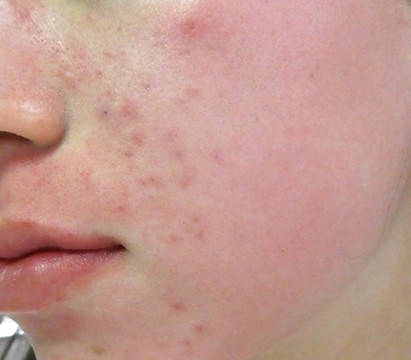 Rosy cheeks are one of the early symptoms of rosacea