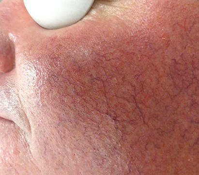 Telangiectasias (spider veins) are one of the symptoms of rosacea