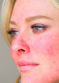 Easily blushing is an early sign of rosacea