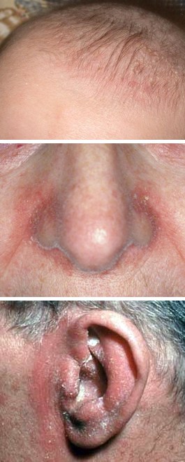 Seborrheic dermatitis affects the various affect the seborrheic areas of the body