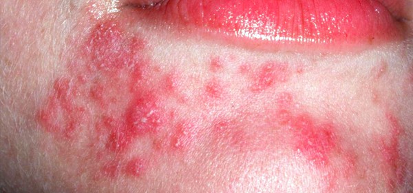Perioral dermatitis predominantly affects women and is a relatively common inflammatory skin disorder of the face.