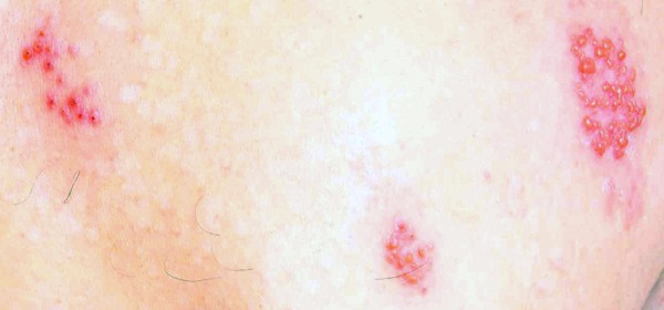 Dermatitis herpetiformis is an inflammatory disease of the skin and is considered the specific cutaneous manifestation of celiac disease.