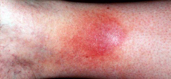 Stasis dermatitis is due to venous insufficiency that causes an itchy, scaly, and hyperpigmented condition of the lower leg. 