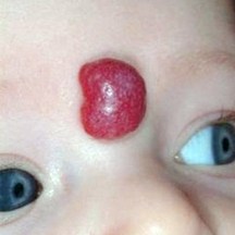 A "Hemangioma" birthmark