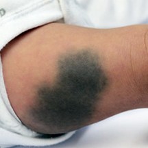 A "Mongolian spot" birthmark