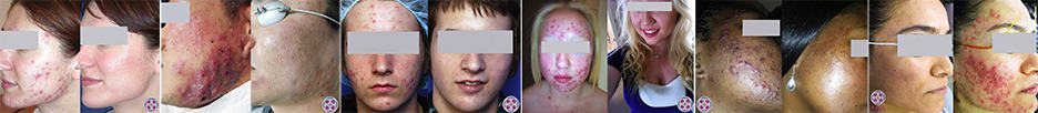 A handful of the many thousands of cystic acne patients we have treated over the years.