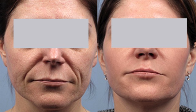 What is a Facelift? Before and After a Nonsurgical Facelift.