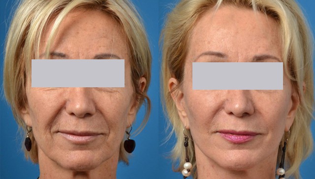 What is a Facelift? Before and After a Surgical Facelift.