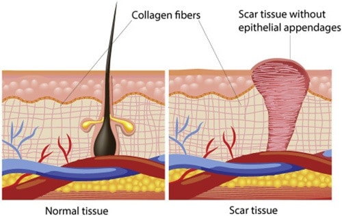 Scar tissue does not have the flexibility of normal skin because the fibers are all oriented in the same direction. The multi-directional complexity of the basket-weave cross linking of healthy collagen is lost.