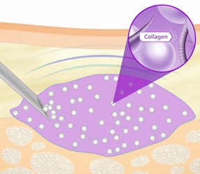 Collagen injected into the dermis will act as a temporary dermal filler and not integrate into the collagen matrix.