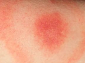 The classic Lyme disease rash