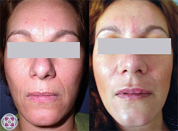 Laser treatments can lift, tone and tighten your skin