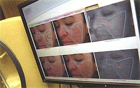 Computerized complexion analysis helps the doctors to see exactly what your skin needs. 