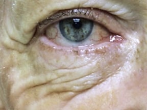 Wrinkles under the eyes