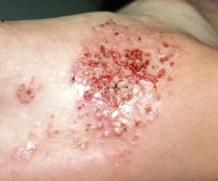 Image of Dyshidrotic Eczema