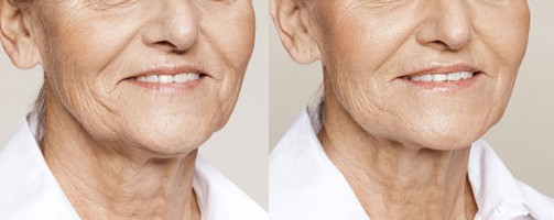 Before and After filler treatment for jowls