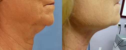 Before and After Bipolar Radio Frequency treatment to reduce the appearance of jowls.