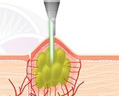 The Nd:YAG Laser targets the sebaceous gland