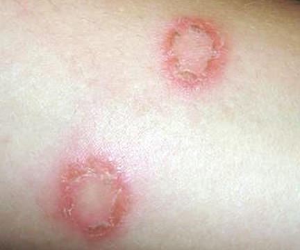 Image of Nummular Eczema