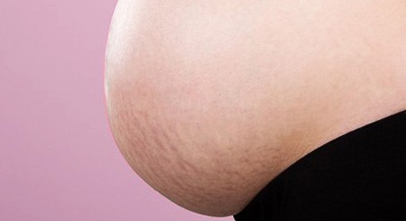 Pregnancy is the number one cause of stretch marks