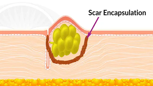 Sebaceous cysts can become encapsulated with scar tissue. When the cyst dries up the skin falls into the encapsulated area leaving you with a pock mark.